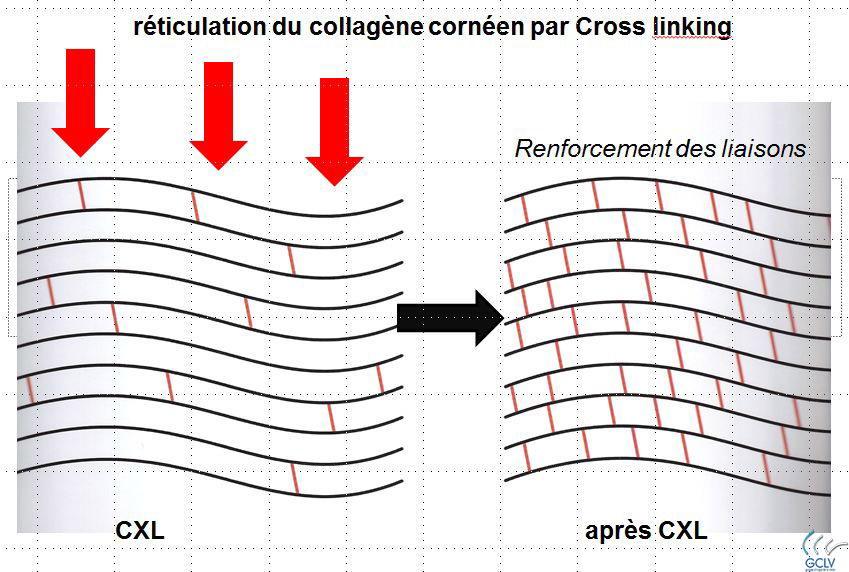 Le Cross-Linkng (CXL